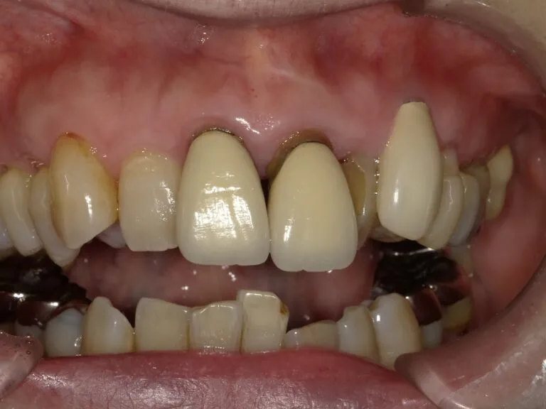 審美治療症例①ー1